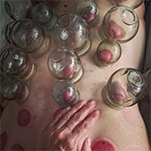 Therapeutic Cupping