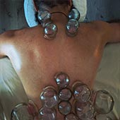 Therapeutic Cupping
