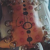 Therapeutic Cupping