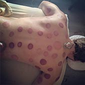 Therapeutic Cupping